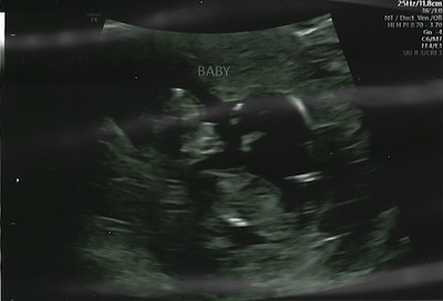 Ultrasound at 11 weeks of pregnancy showing the something that looks like a little human