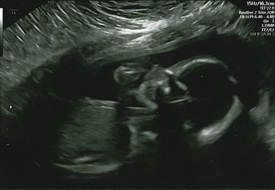 Ultrasound at 20 weeks of pregnancy showing the something that looks like a little human