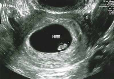 Ultrasound at 6 weeks of pregnancy showing a tiny bean attached to Ariele's uterus